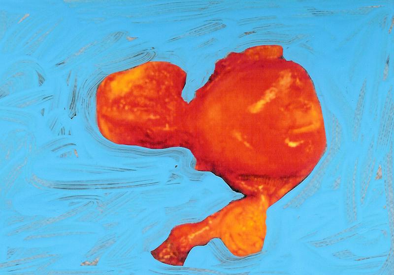 Uterus removed. The melon sized cyst that was removed is not pictured as it had to rush off to get a biopsy.