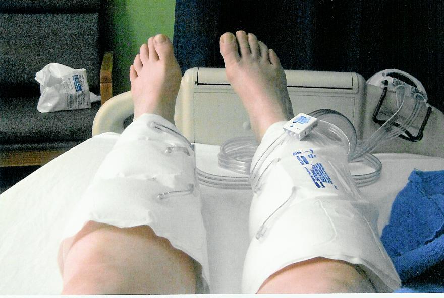 AFTER HYSTERECTOMY I GOT PUFFY LEGS & FEET!